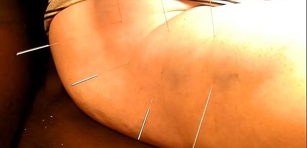  Acupuncture needles 2 with Playerdoi
